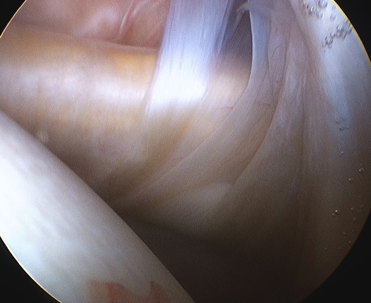 Subscapularis Normal Arthroscopy